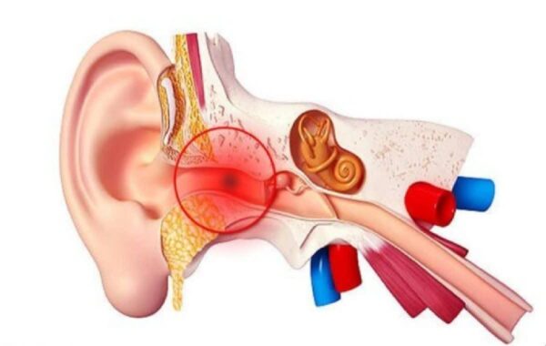 اختلال و تجمع مایع در گوش میانی؛ از کاهش شنوایی تا ارزیابی شنوایی و نقش سمعک